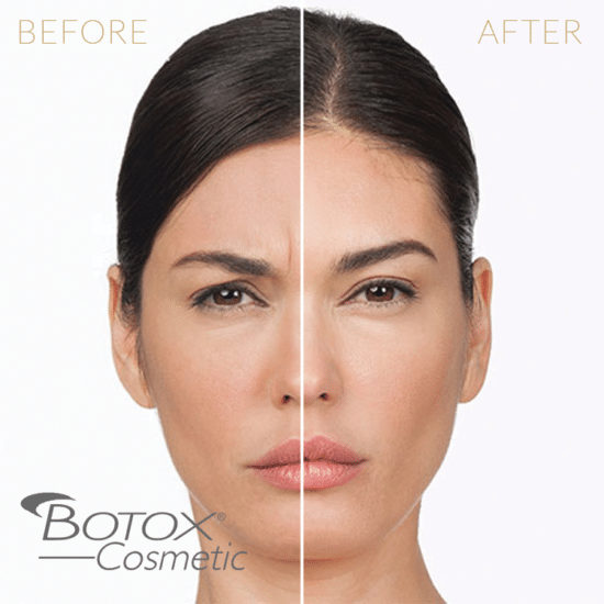 Injectables-Botox