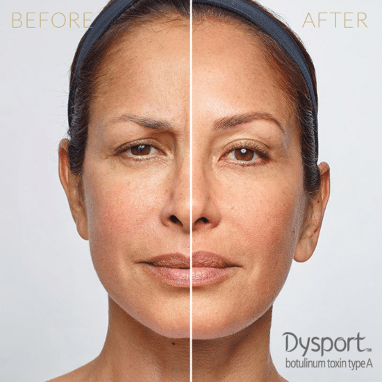 Injectables-Dysport