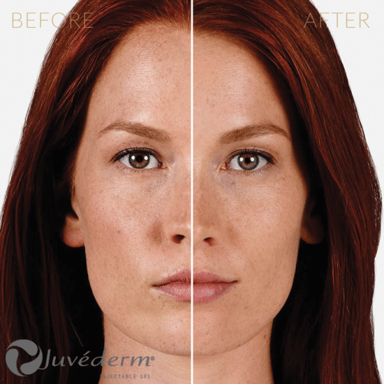 Injectables-Juvederm