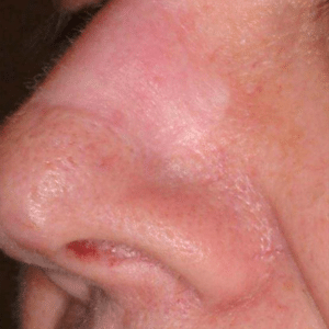 Scar Removal After 2