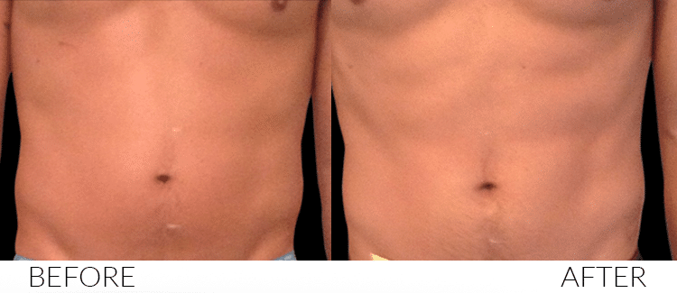 BEFORE AND AFTERS Emsculpt 3