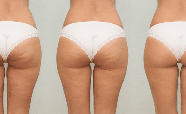 Cellulite Before and After