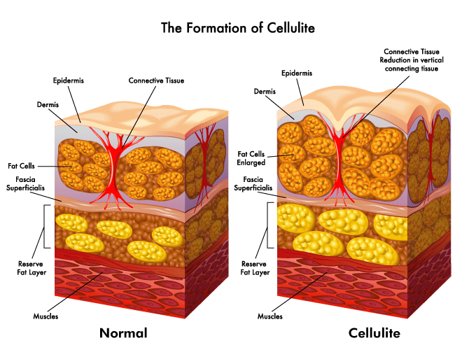 Cellulite Formation