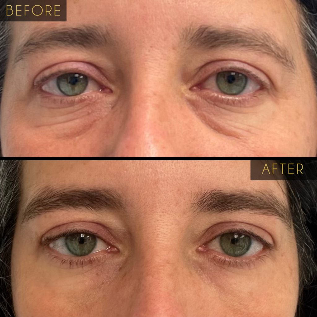 Under Eye Hollow Before and After